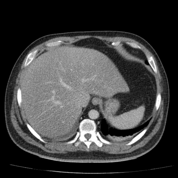 Acute pancreatitis (Radiopaedia 26663-26813 Axial C+ portal venous phase 15).jpg
