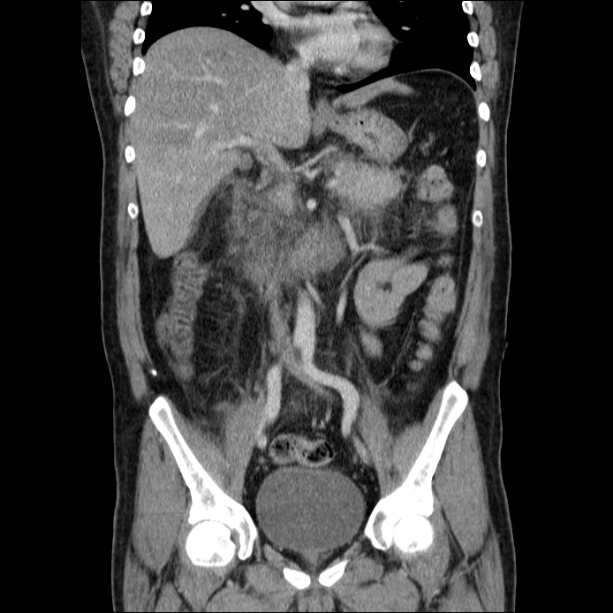 Acute pancreatitis (Radiopaedia 26663-26813 Coronal C+ portal venous phase 34).jpg