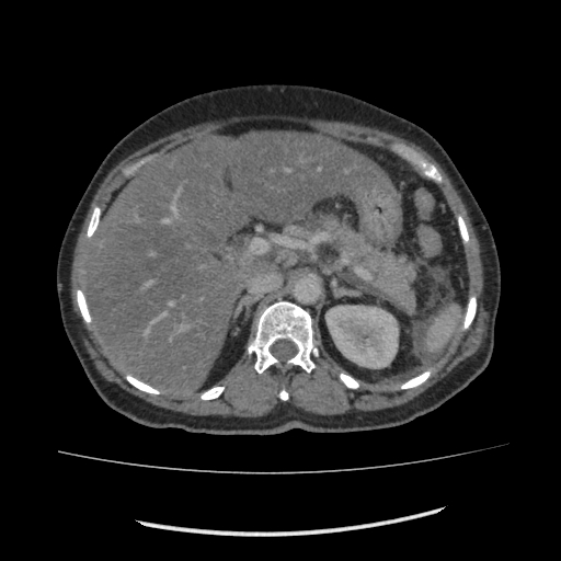 Acute pancreatitis (Radiopaedia 80007-93285 Axial C+ portal venous phase 42).jpg