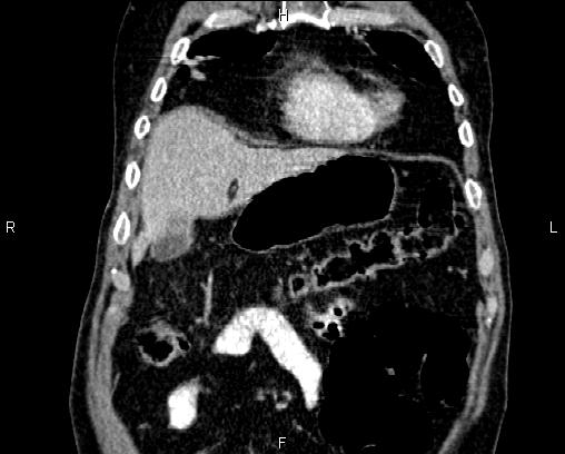 Acute pancreatitis (Radiopaedia 85146-100701 Coronal C+ portal venous phase 12).jpg