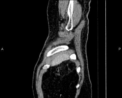 File:Acute pancreatitis (Radiopaedia 85146-100701 Sagittal C+ portal venous phase 2).jpg