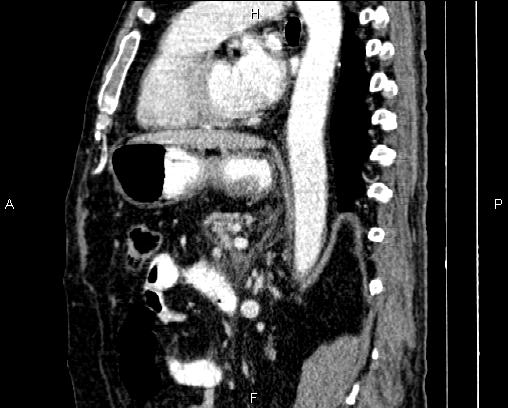 Acute pancreatitis (Radiopaedia 85146-100701 Sagittal C+ portal venous phase 57).jpg