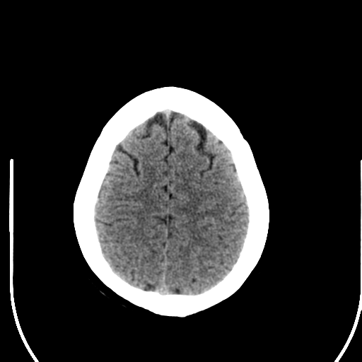 File:Acute pontine infarct from vertebral artery dissection (Radiopaedia 34111-35369 Axial non-contrast 25).png