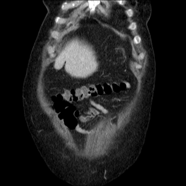 Acute pyelonephritis (Radiopaedia 26584-26729 C+ portal venous phase 14).jpg