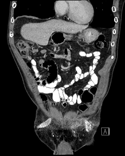 Acute renal infarction - rim capsular enhancement (Radiopaedia 59833-67270 Coronal C+ portal venous phase 6).jpg