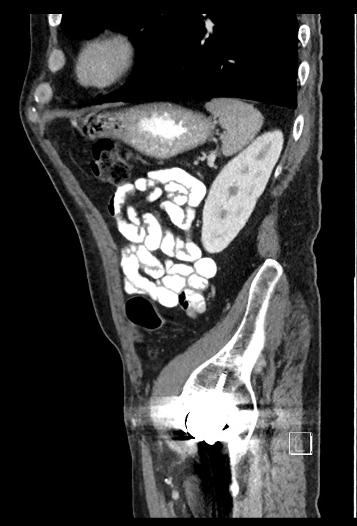Acute renal infarction - rim capsular enhancement (Radiopaedia 59833-67270 Sagittal C+ portal venous phase 25).jpg
