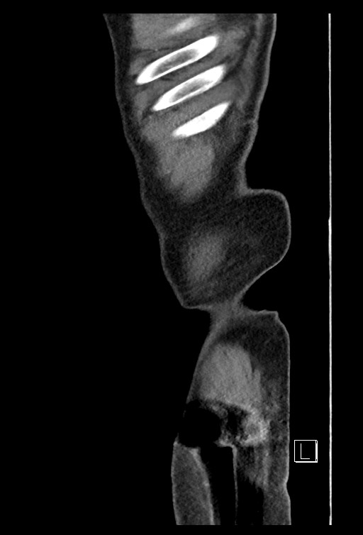 Acute renal infarction - rim capsular enhancement (Radiopaedia 59833-67270 Sagittal C+ portal venous phase 7).jpg