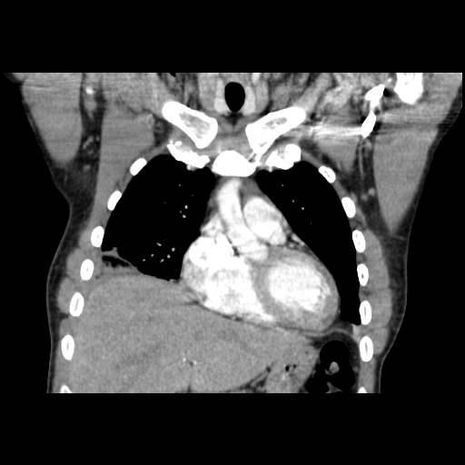 Acute segmental pulmonary emboli and pulmonary infarction (Radiopaedia 62264-70444 Coronal C+ CTPA 13).jpg