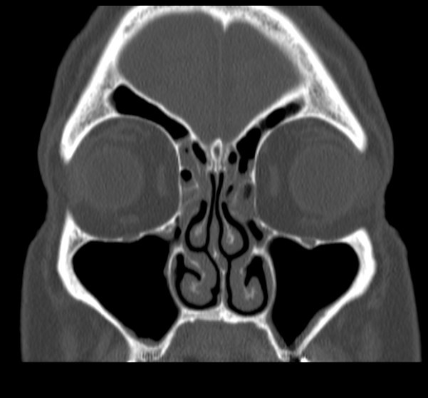 Acute sinusitis (Radiopaedia 23161-23215 Coronal bone window 29).jpg