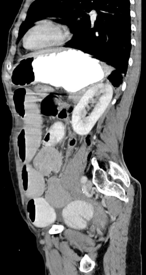 Acute small bowel (ileal) volvulus (Radiopaedia 71740-82139 Sagittal C+ portal venous phase 63).jpg