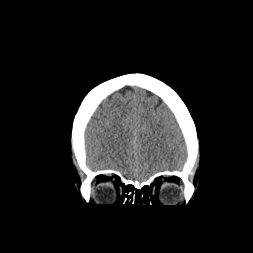 Acute subarachnoid hemorrhage and accessory anterior cerebral artery (Radiopaedia 69231-79008 Coronal non-contrast 19).jpg