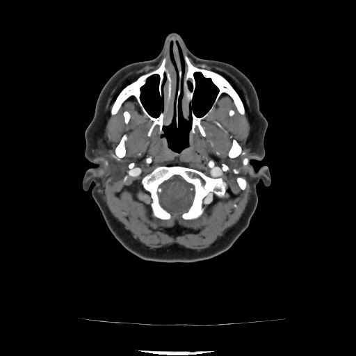 Acute subarachnoid hemorrhage and accessory anterior cerebral artery (Radiopaedia 69231-79009 Axial C+ arterial phase 75).jpg