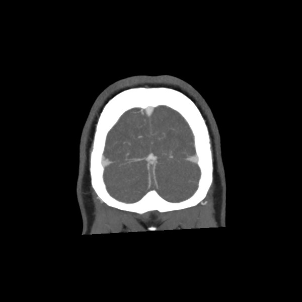 Acute subarachnoid hemorrhage and accessory anterior cerebral artery (Radiopaedia 69231-79009 Coronal C+ arterial phase 74).jpg