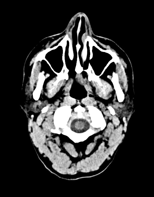 Acute superior cerebellar artery territory infarct (Radiopaedia 84104-99359 Axial non-contrast 66).jpg