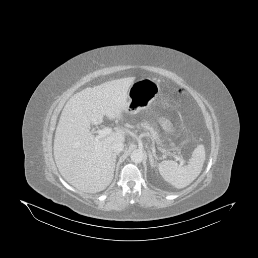 Acute superior mesenteric artery occlusion (Radiopaedia 51288-56960 Axial lung window 8).jpg