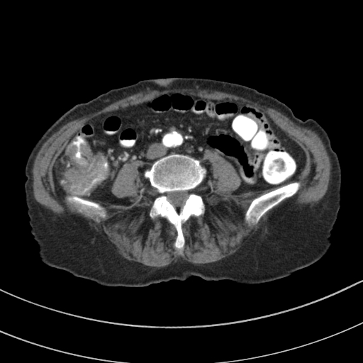Adenocarcinoma of cecum (Radiopaedia 59222-66549 Axial C+ arterial phase 92).jpg