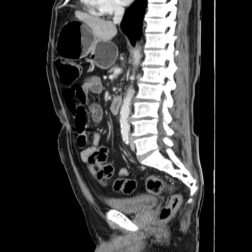 Adenocarcinoma of colon with entero-colic fistula (Radiopaedia 22832-22852 Sagittal C+ portal venous phase 32).jpg