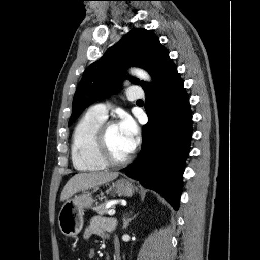 Adenocarcinoma of the lung (Radiopaedia 59871-67325 Sagittal C+ arterial phase 63).jpg