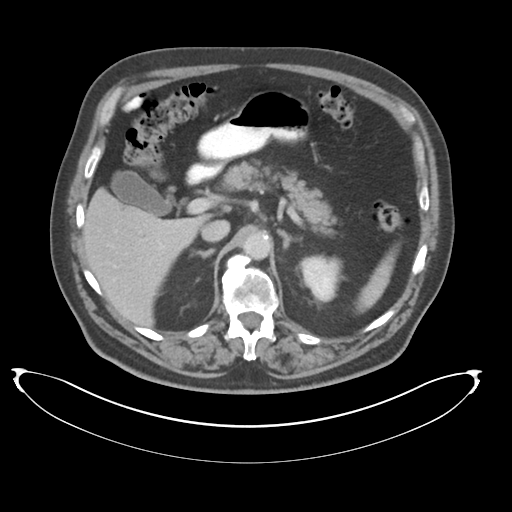 File:Adenocarcioma of rectum- T1 lesion (Radiopaedia 36921-38547 Axial C+ portal venous phase 27).png