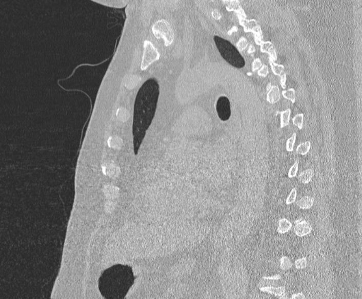 Adenoid cystic carcinoma of the trachea (Radiopaedia 49042-54137 Sagittal lung window 264).jpg