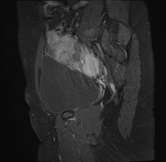 File:Adenomyosis - ovarian endometriomas (Radiopaedia 67031-76350 Sagittal T1 C+ fat sat 5).jpg