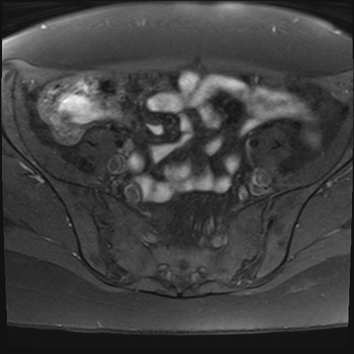 File:Adenomyosis and endometriotic cysts (Radiopaedia 82300-96367 Axial T1 fat sat 26).jpg