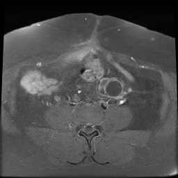 File:Adenomyosis within a didelphys uterus (Radiopaedia 70175-80215 Axial T1 C+ fat sat 12).jpg