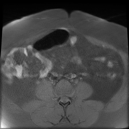 File:Adenomyosis within a didelphys uterus (Radiopaedia 70175-80215 Axial T1 fat sat 7).jpg