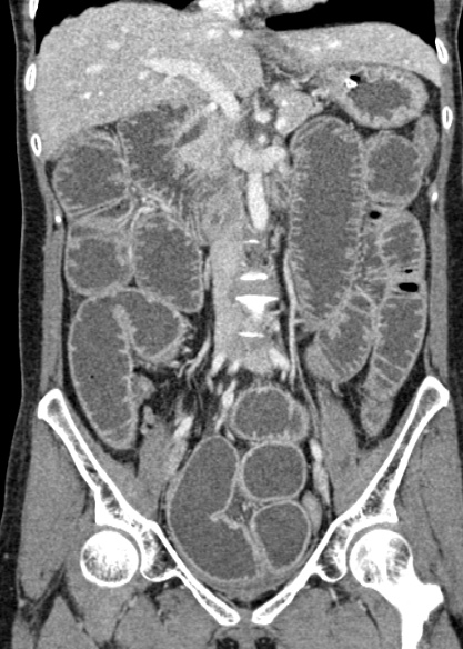 File:Adhesional small bowel obstruction (Radiopaedia 48397-53305 Coronal C+ portal venous phase 170).jpg