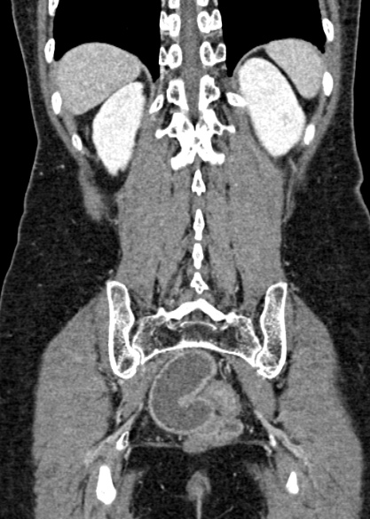 Adhesional small bowel obstruction (Radiopaedia 48397-53305 Coronal C+ portal venous phase 280).jpg