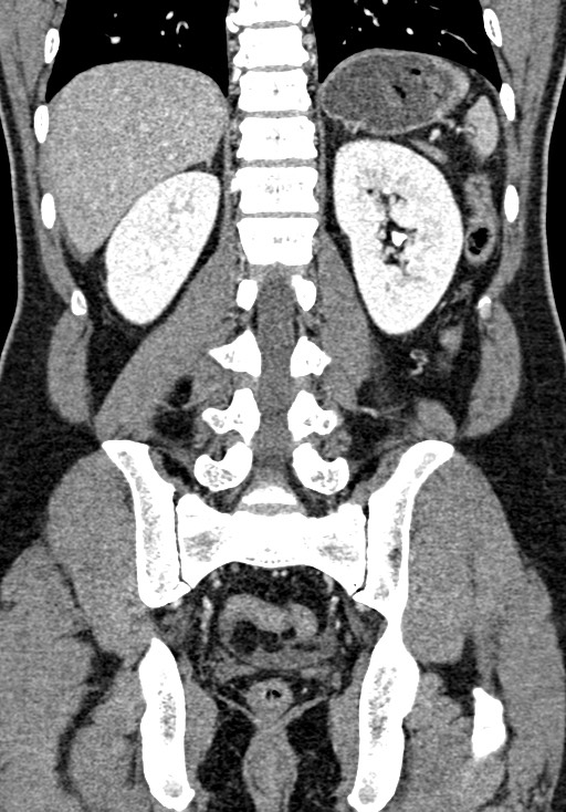 Adhesional small bowel obstruction (Radiopaedia 58900-66131 Coronal C+ portal venous phase 183).jpg