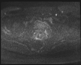 Adnexal multilocular cyst (O-RADS US 3- O-RADS MRI 3) (Radiopaedia 87426-103754 Axial DWI 79).jpg