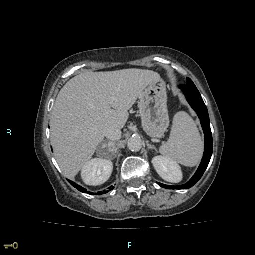 File:Adrenal collision tumor (ACT) (Radiopaedia 48462-53379 Axial C+ delayed 15).jpg