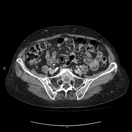 File:Adrenal collision tumor (ACT) (Radiopaedia 48462-53379 Axial C+ portal venous phase 44).jpg