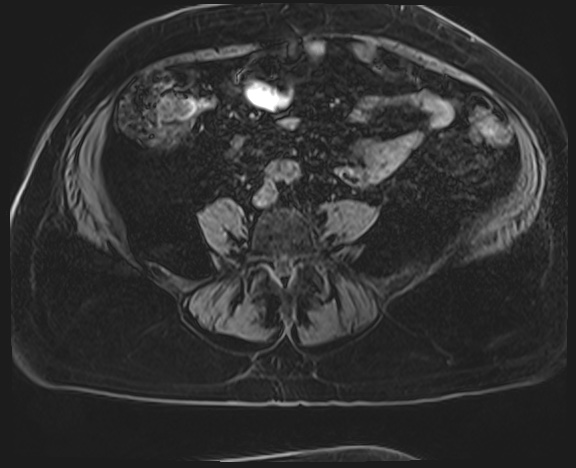 Adrenal cortical carcinoma (Radiopaedia 64017-72770 Axial T1 C+ fat sat 54).jpg