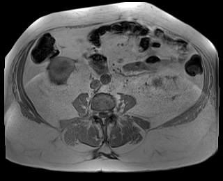 File:Adrenal cortical carcinoma (Radiopaedia 64017-72770 Axial T1 in-phase 59).jpg