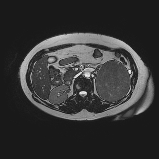 File:Adrenal cortical carcinoma (Radiopaedia 70906-81116 Axial FIESTA 28).jpg
