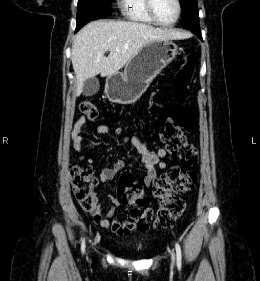 Adrenal cortical carcinoma (Radiopaedia 84882-100379 Coronal C+ portal venous phase 16).jpg
