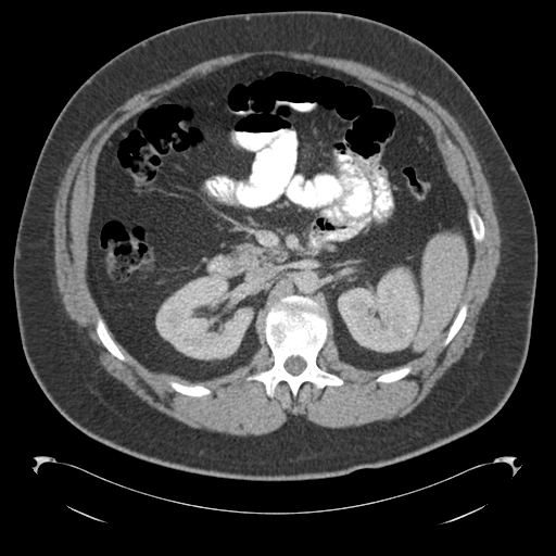 Adrenal cyst (Radiopaedia 45625-49776 Axial C+ portal venous phase 38).png