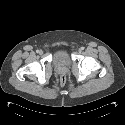 File:Adrenal cyst (Radiopaedia 45625-49776 Axial C+ portal venous phase 96).png