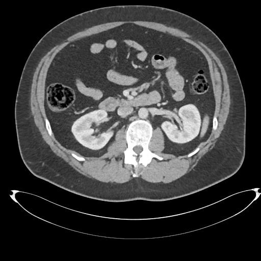 File:Adrenal cyst (Radiopaedia 45625-49778 AXIAL THICK 60 sec 37).png
