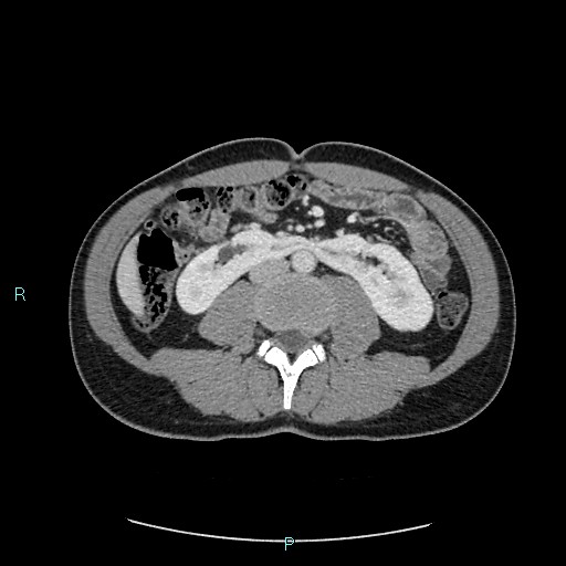 File:Adrenal cystic lymphangioma (Radiopaedia 83161-97534 Axial C+ portal venous phase 51).jpg