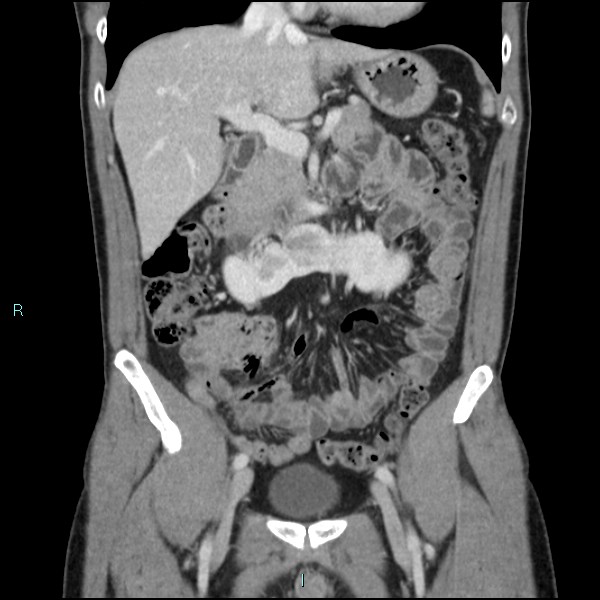 Adrenal cystic lymphangioma (Radiopaedia 83161-97534 Coronal C+ portal venous phase 30).jpg