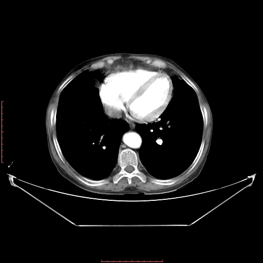Adrenal hemangioma (Radiopaedia 68923-78668 Axial C+ arterial phase 10).jpg