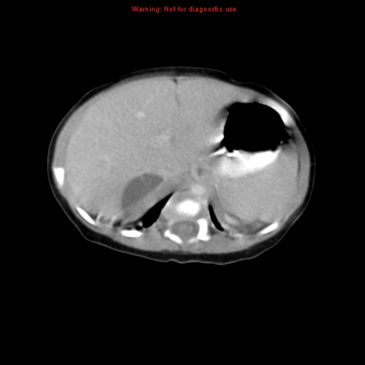 File:Adrenal hemorrhage (Radiopaedia 9390-10077 Axial C+ portal venous phase 4).jpg