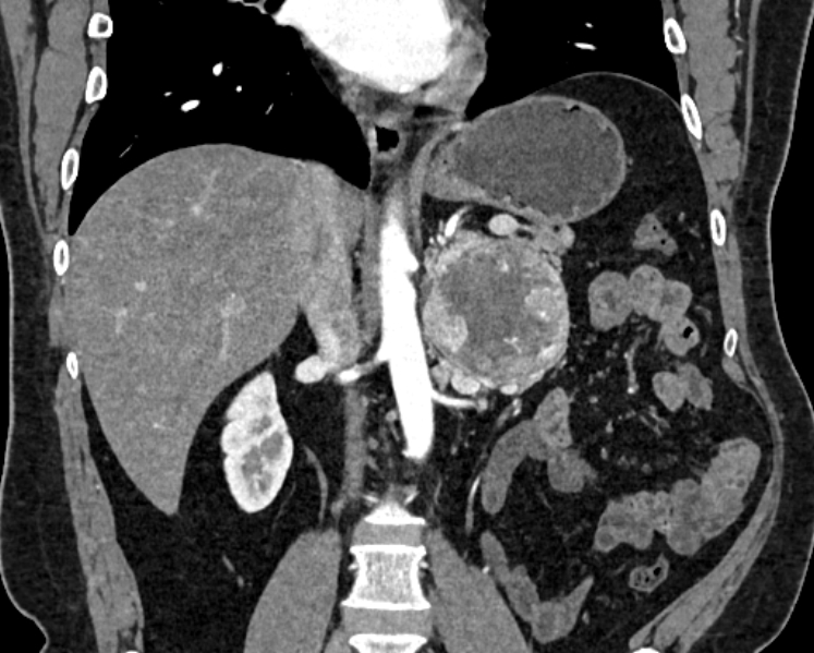 File:Adrenal metastases (Radiopaedia 73082-83791 Coronal C+ arterial phase 27).jpg