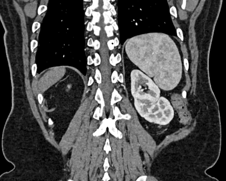 Adrenal metastases (Radiopaedia 73082-83791 Coronal C+ arterial phase 68).jpg