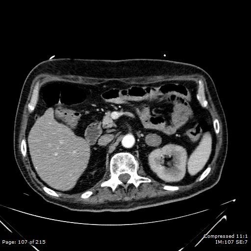 Adrenal metastasis (Radiopaedia 78425-91079 Axial C+ arterial phase 37).jpg