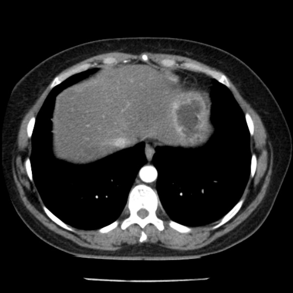 Adrenal myelolipoma (Radiopaedia 43401-46759 Axial C+ arterial phase 9).jpg