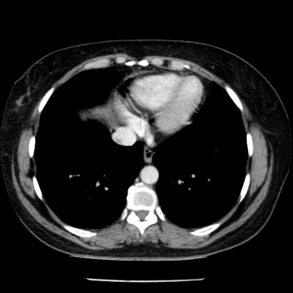 Adrenal myelolipoma (Radiopaedia 43401-46759 Axial C+ portal venous phase 4).jpg